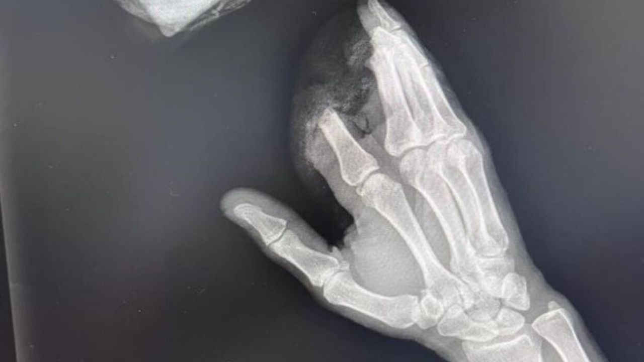 Kopan 3 parmağını poşete koydu hastaneye koştu