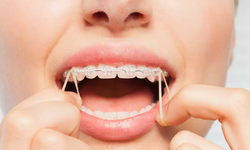 Braket Nedir? Diş Teli Tedavisinde Neden Kullanılır?