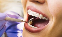 Diş teli tedavisi nedir? Ne kadar sürer?  Maliyeti nedir?