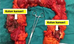 Kolon Kanserine Karşı Beslenme Gerçekten Etkili Mi? Hangi Besinler Koruyucu Olabilir ve Süreç Nasıl Yönetilmeli?