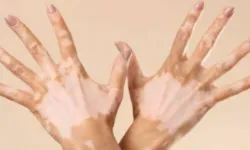 Vitiligo’nun etkileri! Ciltte renk kaybı neden oluyor, Vitiligo’nun tedavisi var mı?