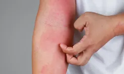 Egzamayı En Hızlı Ne Geçirir, Doğal Bitkiler Gerçekten İşe Yarar mı, Hangi Yöntemler Bilimsel Olarak Etkilidir?