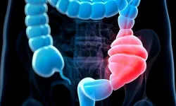 Gençlerde Kolon Kanseri Neden Artıyor? Uzmanlar 5 Önemli Nedene Dikkat Çekiyor