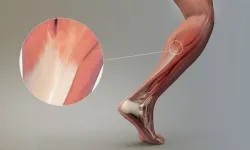 Kas Yırtılması Nedir? Hangi Durumlar Kas Yırtılması Riski Artar ve Nasıl Önlem Alınabilir?