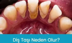 Diş Taşı Neden Oluşur, Evde Temizlenir mi, Yoksa Mutlaka Doktora mı Gidilmelidir?