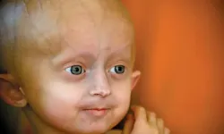 Progeria Nedir, Belirtileri Nelerdir ve Nasıl Teşhis Edilir? Bu Hastalık Neden Yaşlanmayı Hızlandırır?