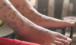 Avrupa’yı Etkisi Altına Alan Ölümcül Mantar Hastalığı Nedir? Ne Kadar Tehlikeli?