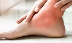 BURKULMA TAM OLARAK NE ANLAMA GELİYOR VE HANGİ YÖNTEMLERLE AĞRI VE ŞİŞLİK HAFİFLETİLEBİLİR?