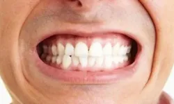 Diş Sıkma Alışkanlığı Nasıl Geçer, Zararları Nelerdir? Uyku ve Gündelik Hayatta Nelere Dikkat Etmeliyiz?