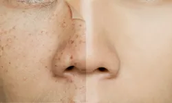 Lekeli Cilt Sorunu mu Yaşıyorsunuz? Bu Hatalardan Kaçının, Cildinizi Koruyun!