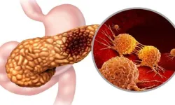 Pankreas İltihaplanması Nedir, Belirtileri Nelerdir ve Hangi Türleri Vardır?