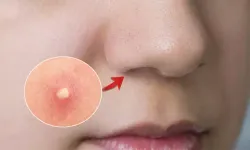Kistik Sivilce Nedir ve Nasıl Geçer? Cilt Sağlığını Etkileyen Bu Sorunun Çözüm Yolları Neler?