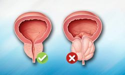 Prostat Kanserinde Erken Teşhis Neden Bu Kadar Önemli, Tedavi Sürecini Nasıl Değiştiriyor?