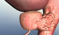 Prostat Büyümesi Nedir, Belirtileri Nelerdir ve Nasıl Tedavi Edilir?