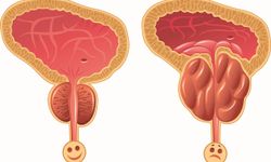 Benign Prostat Hiperplazisi (İyi Huylu Prostat) Nedir, Belirtileri Nelerdir Ve Nasıl Tedavi Edilir?