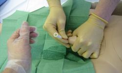 Sonda Nedir? Ne İşe Yarar ve Sonda Takma-Çıkarma İşlemi Neden Yapılır?