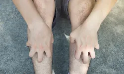 Bacakta Ağırlık ve Kaşıntı Neden Olur, Varisin İlk Sinyalleri Bunlar Olabilir Mi?