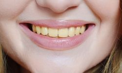 Diş Sararması Neden Olur ve Nasıl Geçer? Beyaz Dişler İçin Bilinmesi Gerekenler
