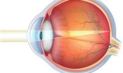 Efraksiyon Bozukluğu Nedir? Gözlerde Görme Kalitesini Bozan Bu Sorun Nasıl Tedavi Edilir?