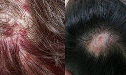 Kafada Sivilce Neden Çıkar? Saç Derisinde Oluşan Bu Can Sıkıcı Sorun Nasıl Geçer ve Tekrar Etmesi Nasıl Önlenir?