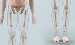 Uzuv Uzatma Nedir, Boy Uzatmak İçin Hangi Egzersizler Yapılır? Gerçekten İşe Yarıyor Mu?