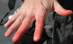 Soğuk ısırmasına dikkat! Yanlış müdahale ampütasyona yol açabilir