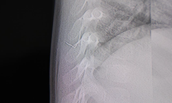 Bebeğin sırtından tel parçası çıktı