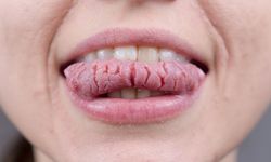 Dilinizde Harita Gibi Lekeler Mi Var, Harita Dil Nedir, Neden Ortaya Çıkar Ve Ne Zaman Ciddiye Alınmalı?