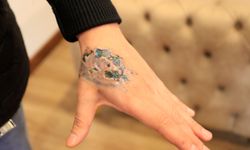 Dövme sildirmek isterken kabusu yaşadı, elindeki dokular öldü