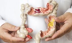 Kolon Kanseri Riski Neden Artıyor? Hangi Alışkanlıklar Tehlike Oluşturuyor ve Erken Teşhis Hayat Kurtarabilir mi?