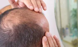 Saç Ekimi Tarih mi Oluyor? Bilim İnsanları Laboratuvarda Gerçek Saç Kökü Üretmeyi Başardı