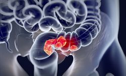 Uzmanlardan Kritik Uyarı! Türkiye’de Her Yıl 22 Bin Kişiye Kolon Kanseri Tanısı Konuyor