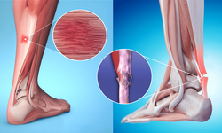 Bacak Ağrısı ve Uyuşma Neyi İşaret Ediyor? Dolaşım Bozukluğu Hakkında Bilmeniz Gerekenler