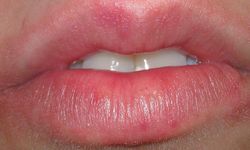 Dudak Şişmesi Neden Olur, Basit Bir Sorun mu Yoksa Ciddi Bir Hastalığın Habercisi mi?