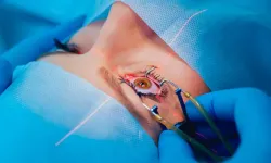 Göz Lazerinde Yeni Yöntem! Smile Pro Lazer Nedir, Kimlere Uygulanır?