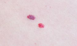 Kırmızı Ben Nedir, Neden Çıkar? Kanser Riski Var mı? İşte Bilmeniz Gerekenler!