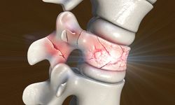 Omurga Kırıkları Nedir? Omurga Kırığı Neden Olur ve Tedavisi Nasıl Yapılır?