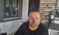 Onur Akay Pitbull Saldırısı Sonrası Entübe Edildi