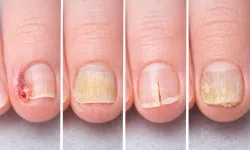 Tırnaklardaki Değişimler Ne Anlama Geliyor? Renk, Şekil ve Kırılmalar Hangi Hastalıkların Habercisi Olabilir?
