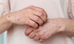 Beriberi Hastalığı Nedir? Beriberi Hastalığının Belirtileri ve Tedavisi Nelerdir?