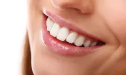 Gülüşünü Değiştirmek İsteyenler Dikkat! Diş Törpüleme Hakkında En Çok Merak Edilenler