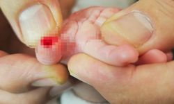 Serum çıkarma işlemi esnasında sargıyla birlikte bebeğin parmağı kesildi