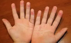 Elde Deri Soyulması Neden Olur? İşte Ellerdeki Soyulmanın En Yaygın Nedenleri