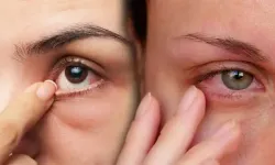 Göz Batması Neden Olur? Gözde Kum Var Gibi Hissediyorsanız Dikkat