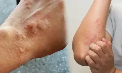 Yaz Sıcakları Kurdeşen Ataklarını Tetikleyebilir! İşte Dikkat Edilmesi Gerekenler