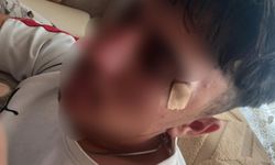 Öğretmenin kafa attığı 16 yaşındaki öğrencinin burnu kırıldı