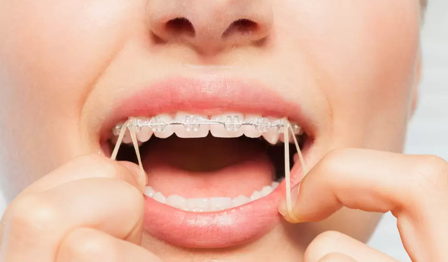 Braket Nedir? Diş Teli Tedavisinde Neden Kullanılır?