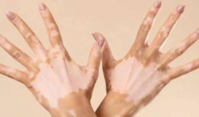 Vitiligo’nun etkileri! Ciltte renk kaybı neden oluyor, Vitiligo’nun tedavisi var mı?