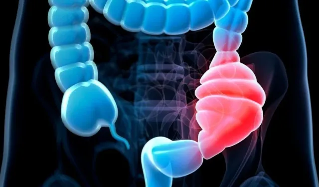 Gençlerde Kolon Kanseri Neden Artıyor? Uzmanlar 5 Önemli Nedene Dikkat Çekiyor