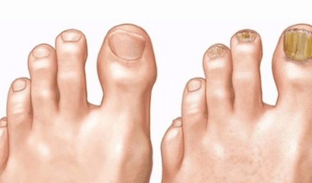 Ayak Mantarı Nedir? Neden Olur Ve Tedavisi Nasıl Yapılır?